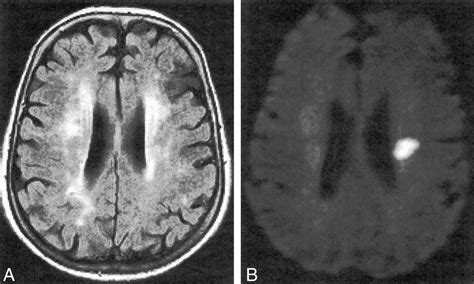 Diffusion Weighted Mr Imaging In The Acute Phase Of Transient Ischemic