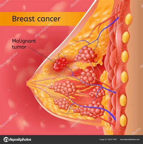 Womans Brest Cancer Vector Anatomical Scheme Stock Vector By TeraVector