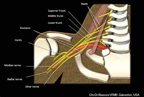Cartoon Of The Anatomy Of The Brachial Plexus Download Scientific