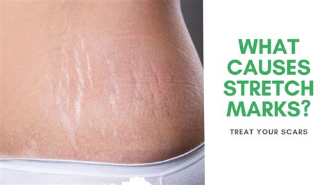 What Causes Stretch Marks Treat Your Scars