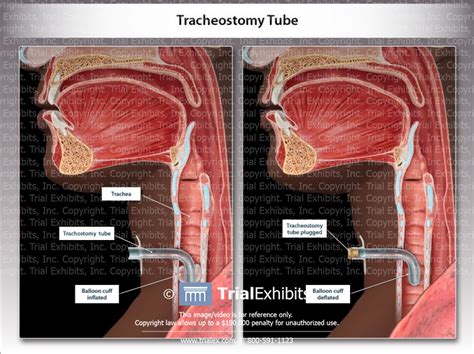 Tracheostomy Tube Trialexhibits Inc