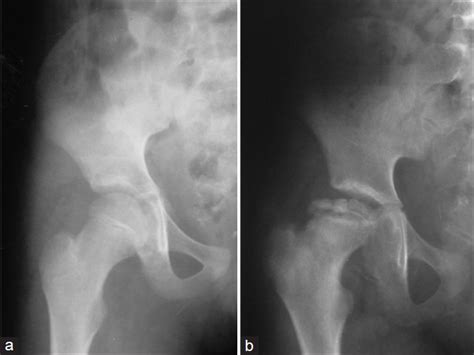 Surgical video 2019 congress rating (1). X-ray right hip joint anteroposterior view of a 11-year ...