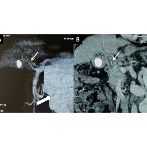 Preoperative Ct Portography Showing Markedly Attenuated Portal Vein