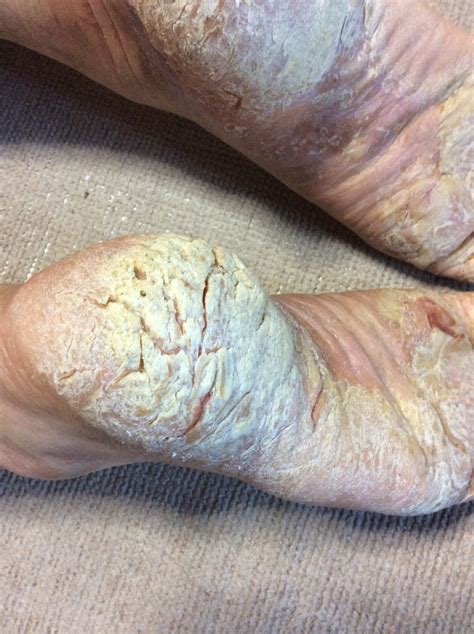 ぱっくり 割れ 治し 方 | 足の指の間のぱっくり割れ ...