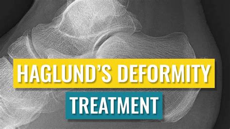 Haglund S Deformity Treatment Youtube