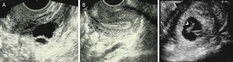 Transvaginal Ultrasound Scan Images Post Re Implantation A Two Antral