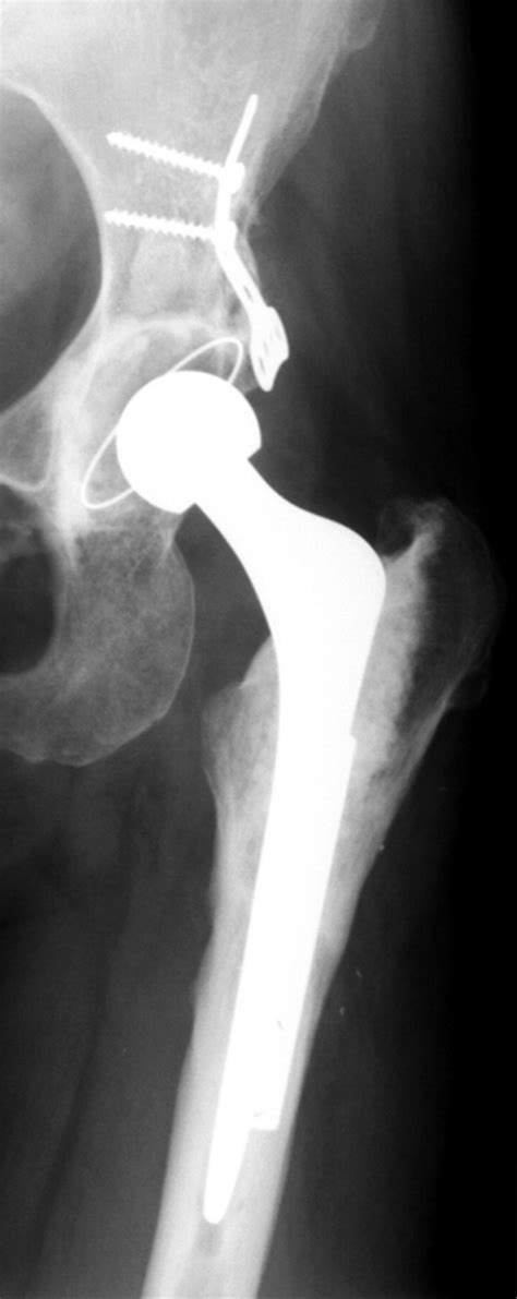 Treatment Of Crowe Iv High Hip Dysplasia With Total Hip Replacement