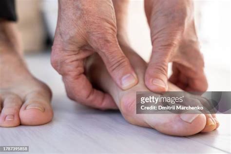 Toe Deformity Photos And Premium High Res Pictures Getty Images