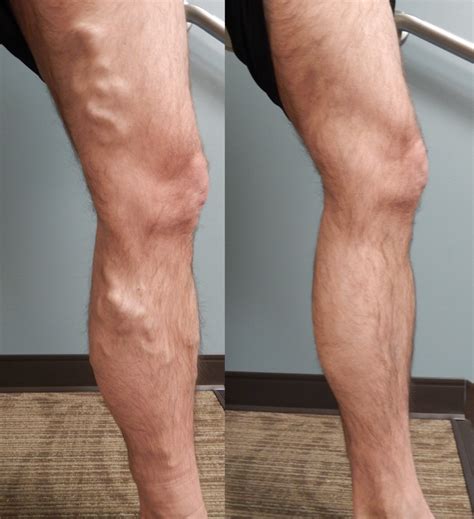 Before And After Photos Pictures Of Varicose Leg Veins Happy Patients