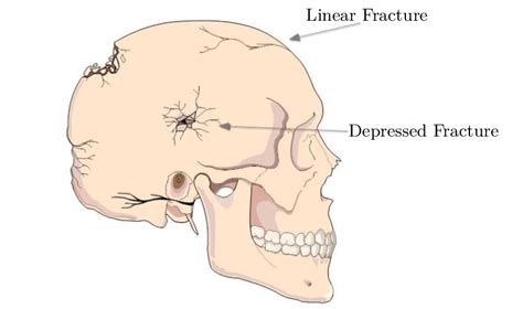 7 Schematic Representation Of A Linear And Depressed Fracture Adapted