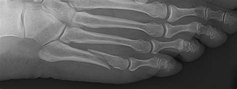 5th Metatarsal Fracture Dr Ben Beamond Adelaide