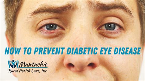 How To Prevent Diabetic Eye Disease Mantachie Rural Health Care Inc