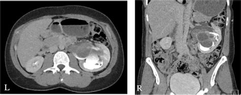 Preoperative Ct Scan Of The Abdomen And Pelvis With Intravenous