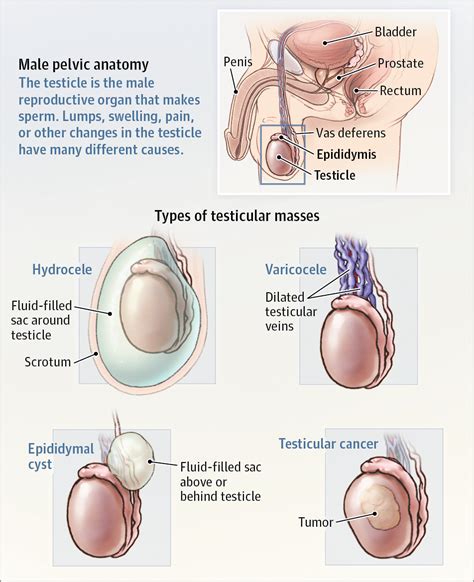 testicular mass oncology jama the jama network