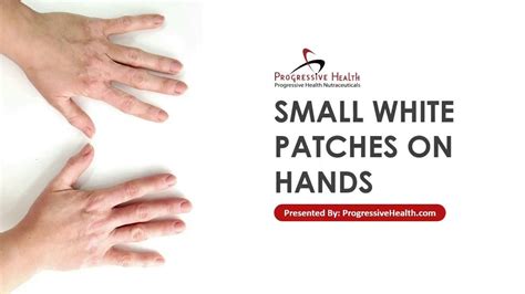 Small White Patches On Your Hands Can Be Caused By A Number Of Things