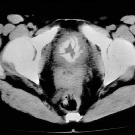 Computered Tomography Scan Showed Massive Calcification Of Bladder Wall