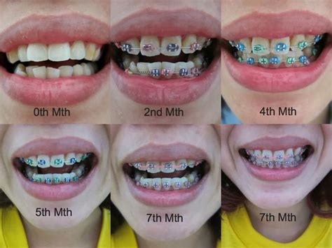 I Like The 4thmonth Color Comment Which Colors U Like Braces Tips