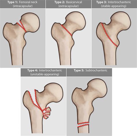 Schematic Of A Typical Classification Of Femoral Fracture Patterns