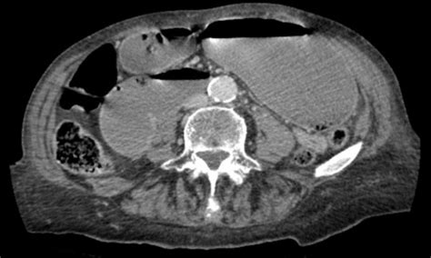Ct Scan Indicating Markedly Dilation Of Stomach And Proximal Duodenum