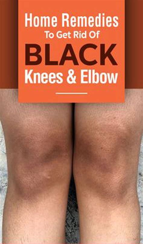 10 Natural Tricks To Remove Dark Knees And Elbows In 2020 With Images