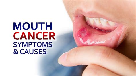 Mouth Cancer Symptoms And Causes Dr Anwar Amir Ansari Cancer Hope