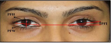 Palpebral Fissure Measurements Pfw Distance Between The Medial And