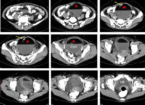 Mature Cystic Ovarian Teratoma Radiology Cases