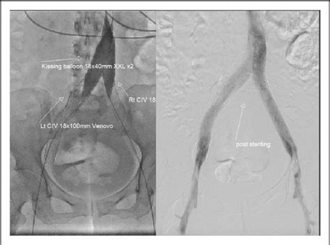 Figure 3 From Use Of The Venovo™ And Sinus Obliquus™ Venous Stents In