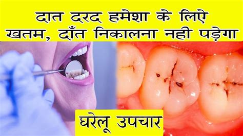 5 मिनट में दांत दर्द ख़त्म घरेलू इलाज Home Remedy For Toothachedant