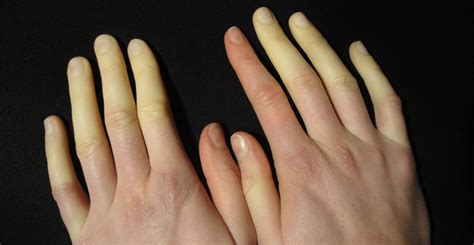 Clinical Clues And Treatments For Raynauds • The Medical Republic