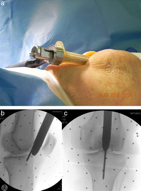 Suprapatellar Nailing Of Tibial Fracturesindications And Technique