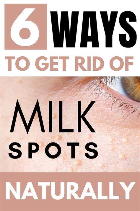 How To Get Rid Of Milk Spots In 2020 Spots On Face How To Get How