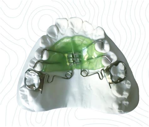 Pendulum Ort Orthodontics Dental Retainer Orthodontic Appliances