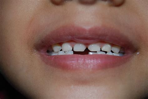 Cabutan gigi susu yang terlalu awal boleh menyebabkan kesesakan pada rahang akibat pergerakan gigi dan akhirnya boleh menyebabkan tiada ruang yang secukupnya untuk gigi kekal tumbuh. Gigi Susu Fatini
