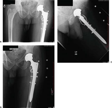 Fully Porous Coated Stems For Femoral Revision Musculoskeletal Key