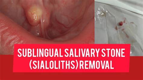 Sublingual Salivary Stone Removal Sialolithiasis Treatment Dr