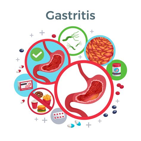 Acute Gastritis Fully Explained Mi Body Health