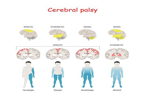 Types Of Cerebral Palsy Gambaran
