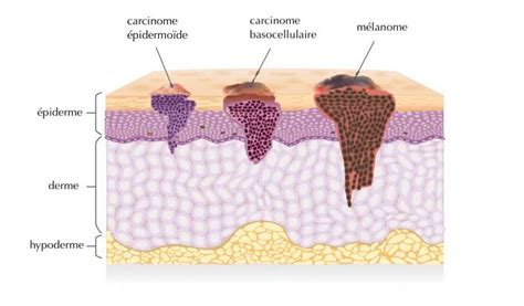 Qual é A Diferença Entre Carcinoma E Melanoma Sublimis