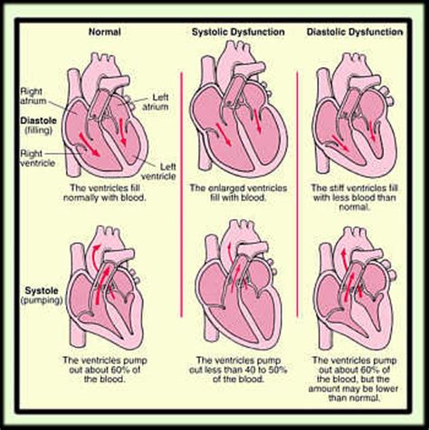 Heart Failure Congestive Heart Failure Hubpages