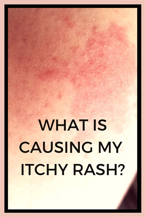 What Is Causing My Itchy Rash Thegoodlife4us Itchy Rash Rashes Images