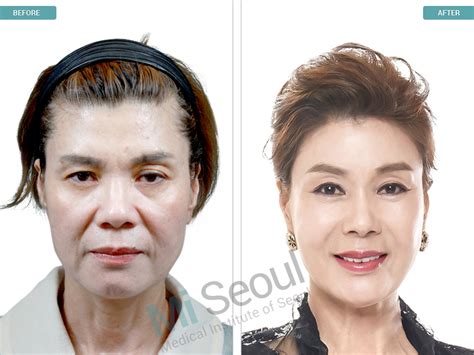 It will immediately make you look young by injecting your own fat into an area where it needs volume. Fat Grafting Korea