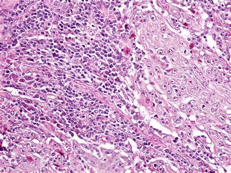 Squamous Cell Carcinoma Poorly Differentiated He Staining