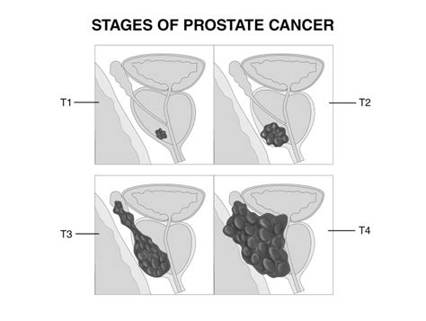 Prostate Cancer Risk Assessment A Sensible Guide To Appropriate