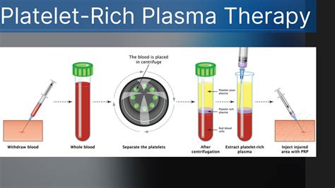 Platelet Rich Plasma Prp