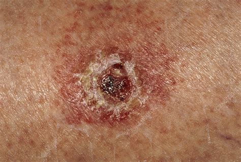 Basal Cell Carcinoma On Leg Of Elderly Woman Stock Image M Science Photo Library