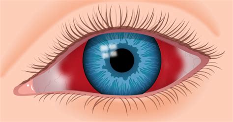 Blood In Eye Subconjunctival Hemorrhage Causes And Treatment