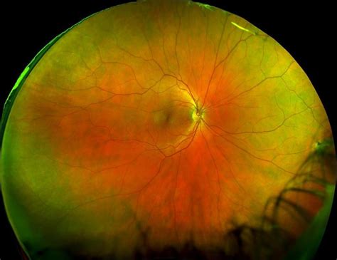 Optomap Ultra Wide Retinal Imaging Del Rey Optometry