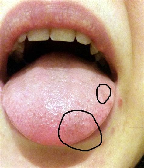Lie Bumps On Tongue Home Remedy