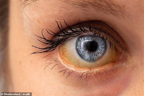 Woman Diagnosed With Cancer After Being Told Her Yellow Eyes Were